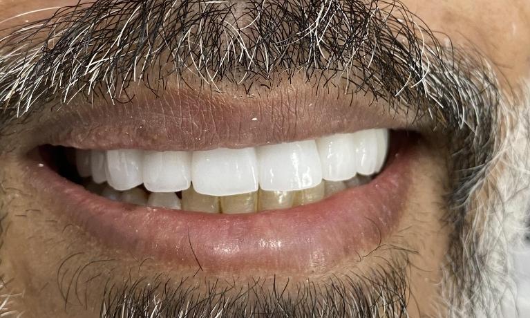 Veneers-After-Image