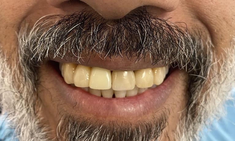 Veneers-Before-Image