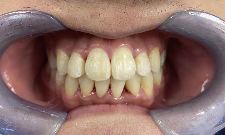 Orthodontic-Crowding-After-Image