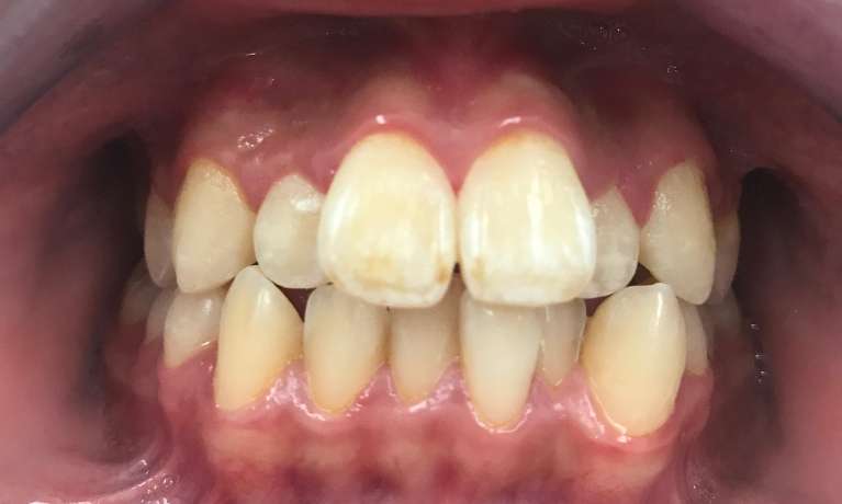 Orthodontic-Crowding-Before-Image